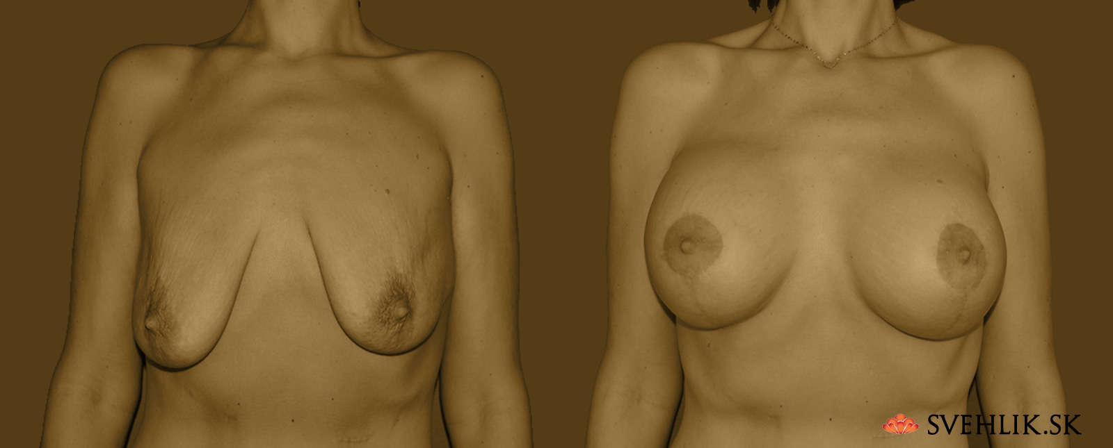 Kombinovaný operačný zákrok – augmentácia a modelácia prsníkov - Pred/Po